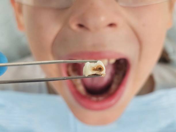 Best Emergency Tooth Extraction in Kamiah, ID